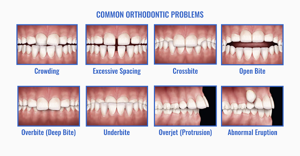 How to Know if Your Child Needs Orthodontics